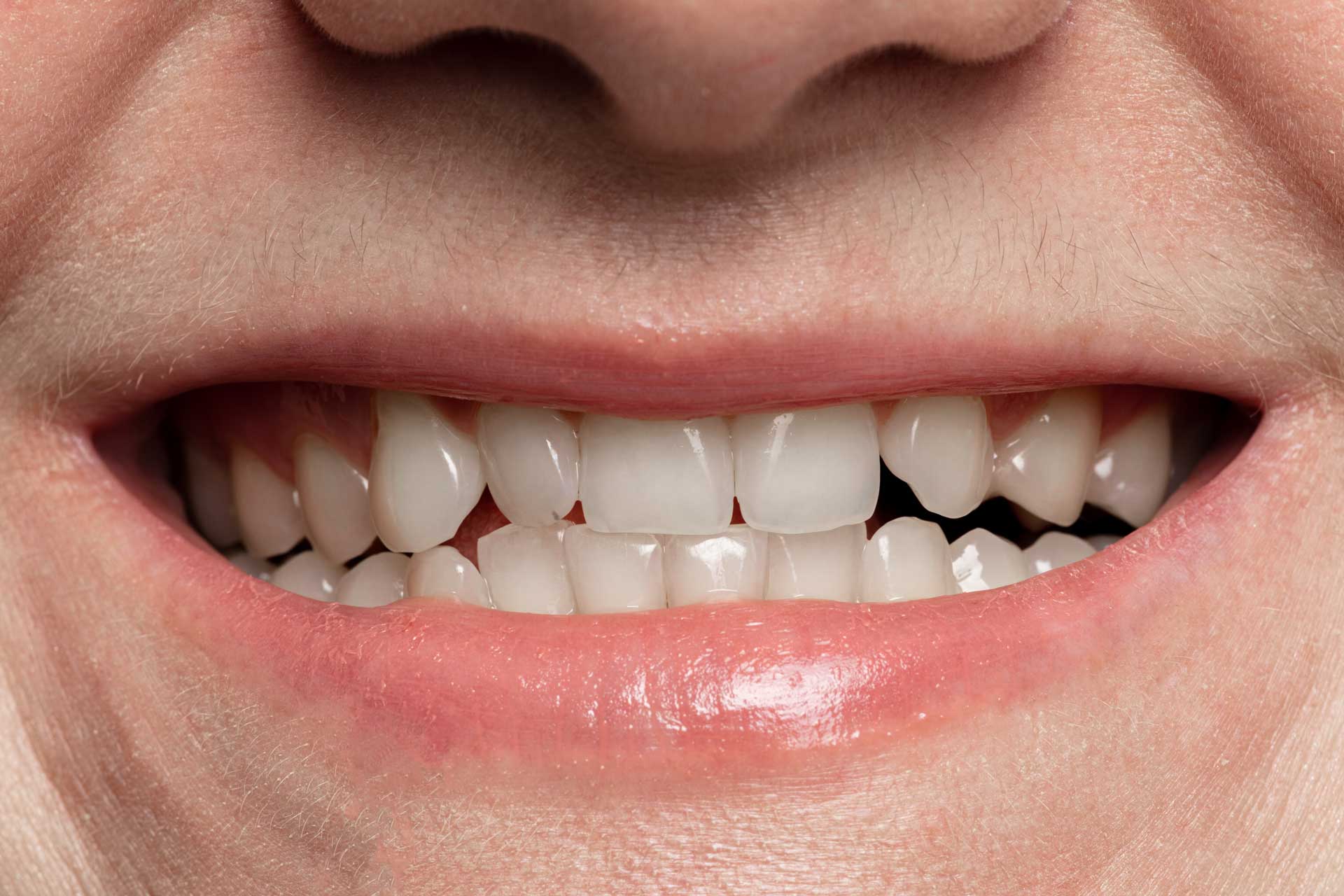 After whitening