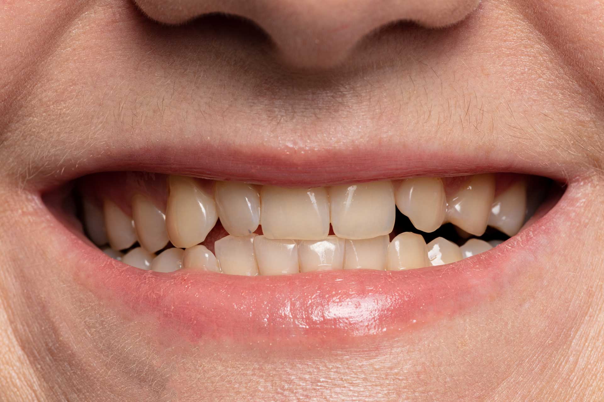 Before whitening